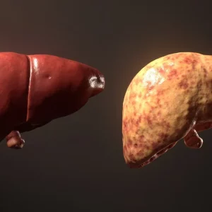 مقایسه کبد سالم و کبد چرب گرید 2