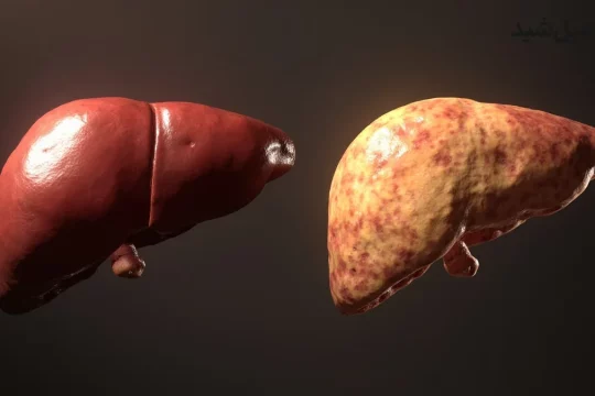 مقایسه کبد سالم و کبد چرب گرید 2