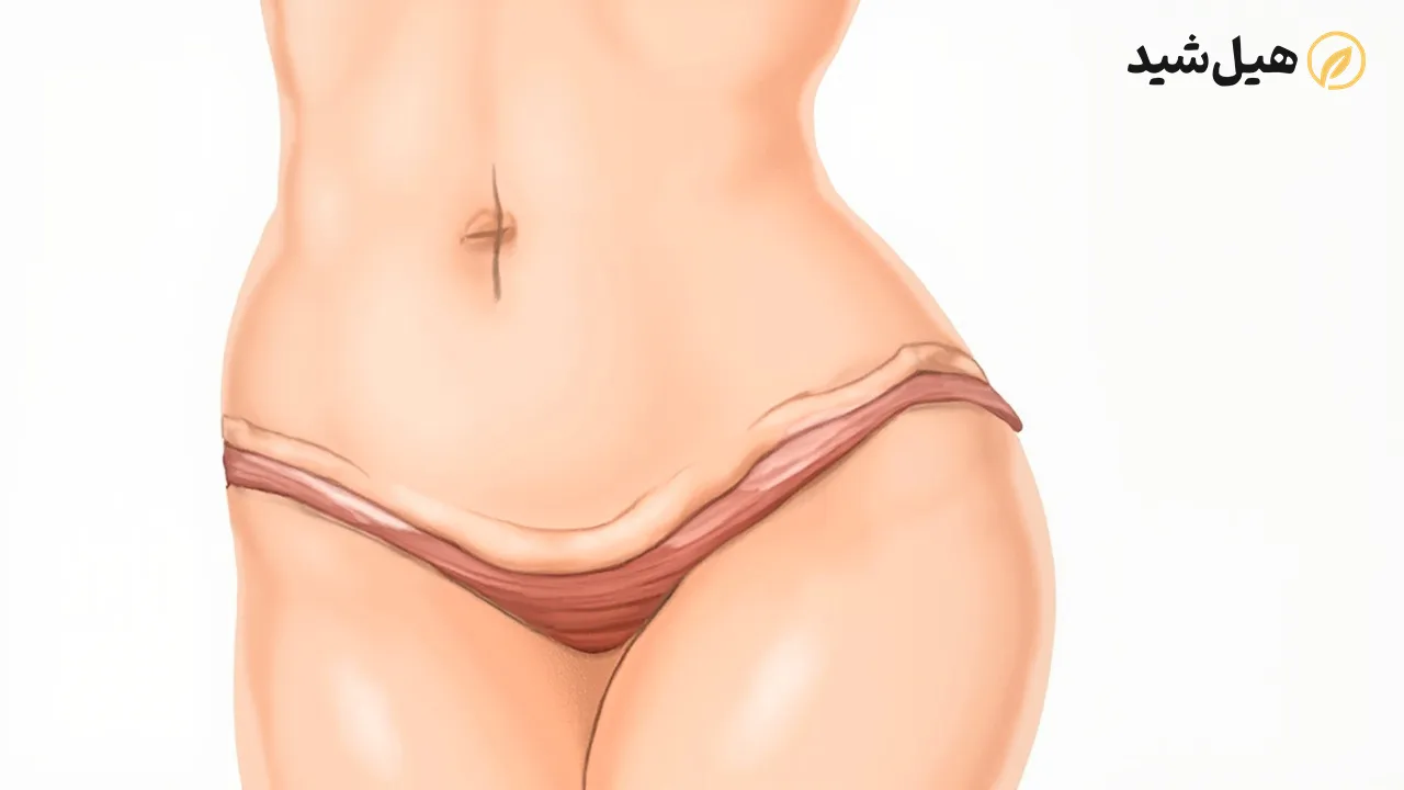 نشانه‌های پوست شل و چربی اضافه در ناحیه شکم قبل از جراحی ابدو
